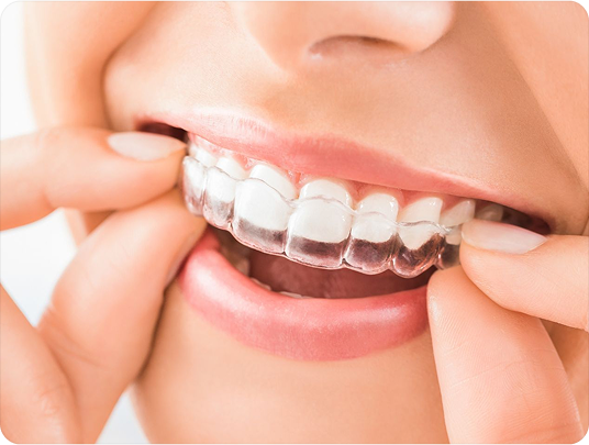 Angel Aligner